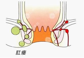 肛瘺的最新治療方法